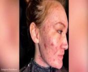 Women with very bad acne from acn sex