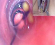 Mature Woman, Peehole Endoscope Camera in Bladder with Balls from stim 99 sex