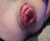 Anal Addicted Prolapse from fist time girl and boy blood xxx