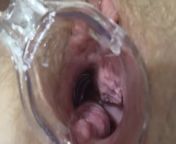 Mature lesbians play in a gynecologist, open the vagina with a medical dilator, examine the cervix. from utirus